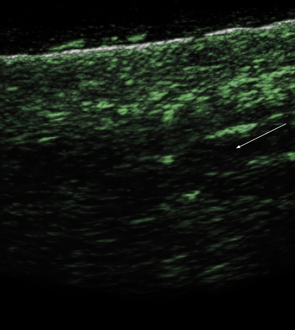 Ảnh siêu âm hoặc scan nghiên cứu