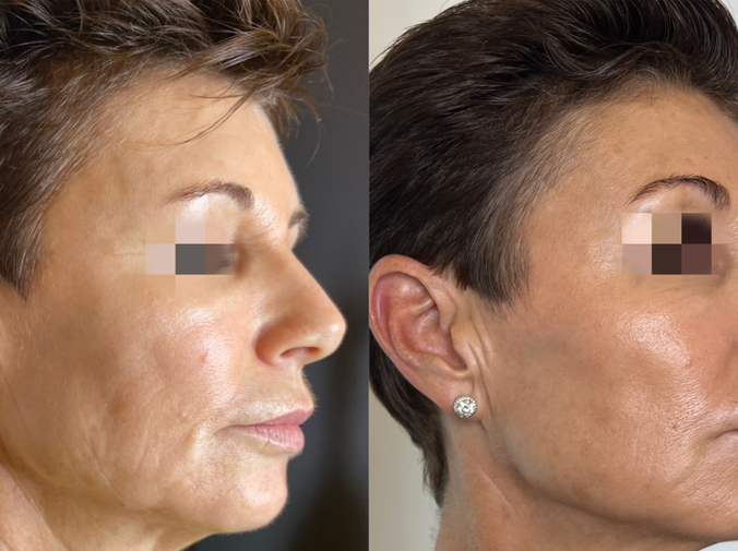 Before & After - Full Face