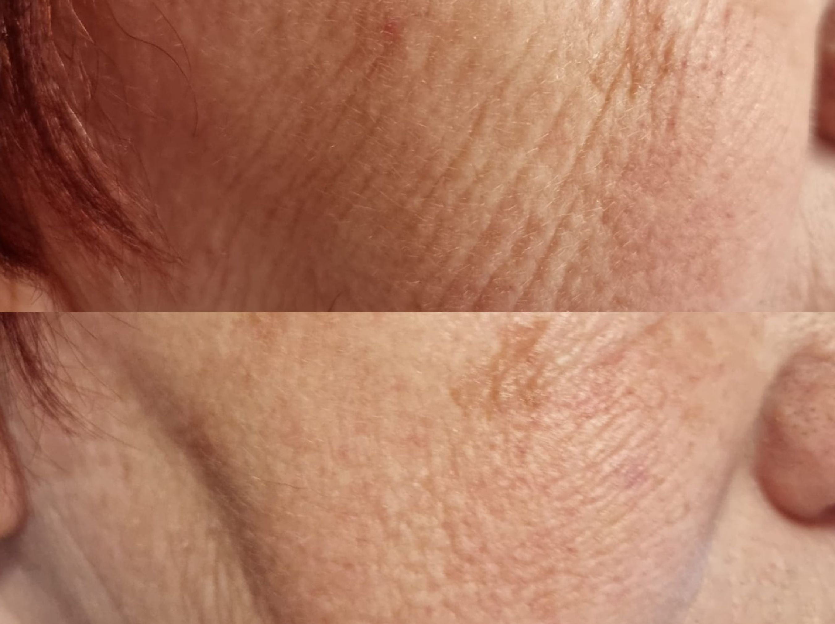 Before & After - Full Face