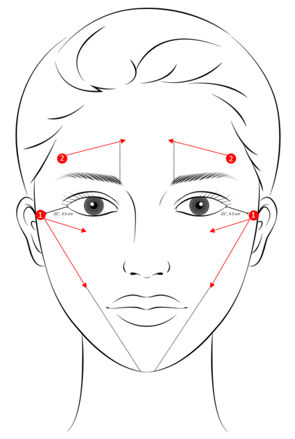 Cannula Protocol - sơ đồ các điểm đưa và hướng đưa trên khuôn mặt