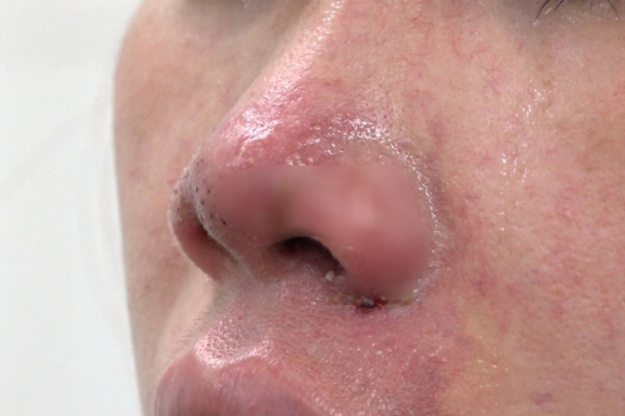 biến chứng filler tắc mạch máu làm hoại tử vùng da