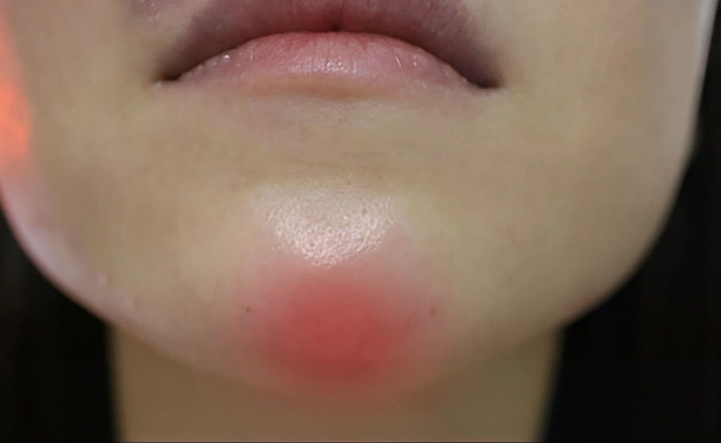 Biến chứng filler